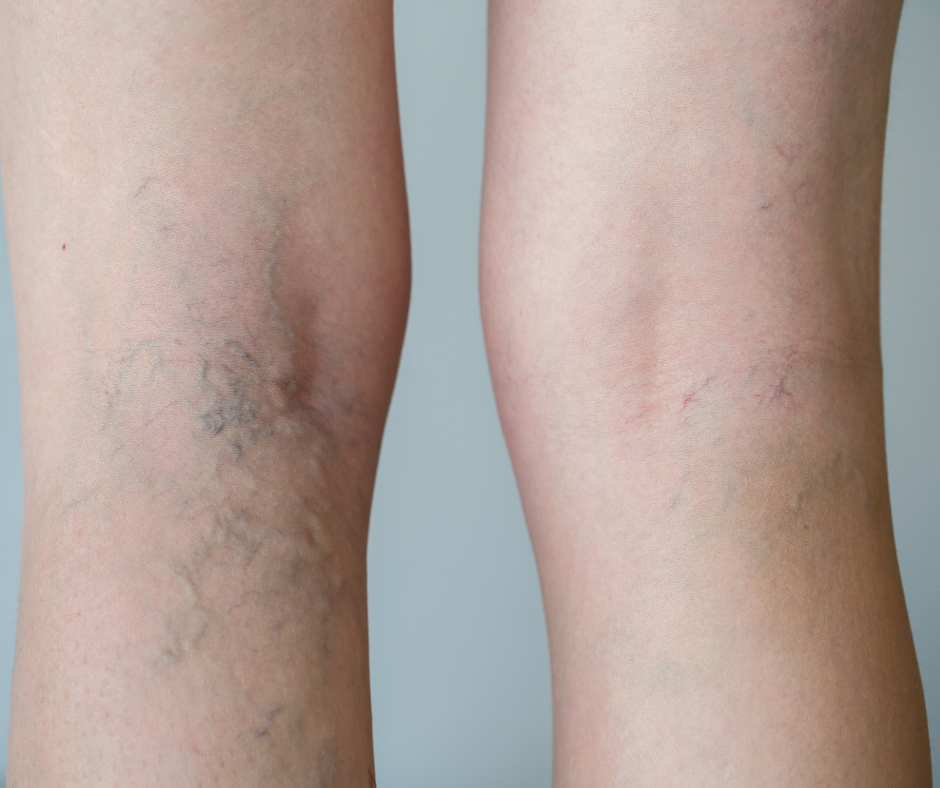 Síntomas y causas de las varices